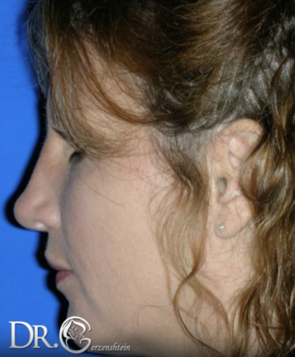 Rhinoplasty Before & After Patient #13463