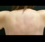 Brachioplasty Before & After Patient #15967