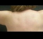 Brachioplasty Before & After Patient #15967