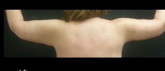 Brachioplasty Before & After Patient #15967