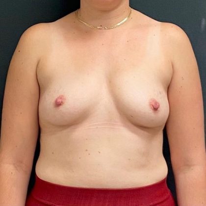 Breast Augmentation Before & After Patient #15982