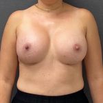 Breast Augmentation Before & After Patient #15982