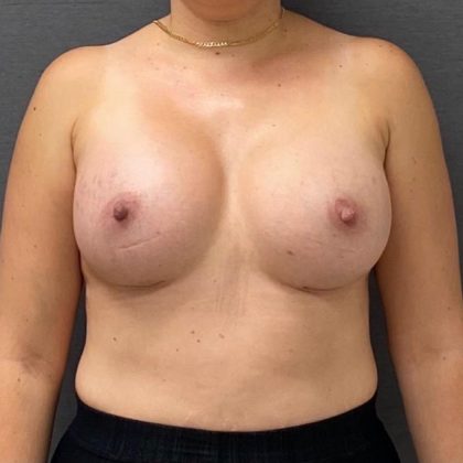 Breast Augmentation Before & After Patient #15982