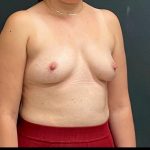Breast Augmentation Before & After Patient #15982