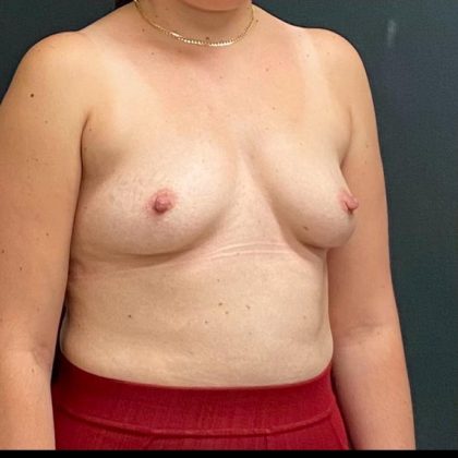 Breast Augmentation Before & After Patient #15982
