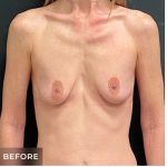 Breast Augmentation Before & After Patient #15983