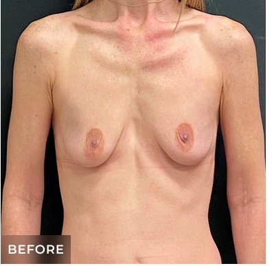 Breast Augmentation Before & After Patient #15983