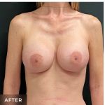 Breast Augmentation Before & After Patient #15983