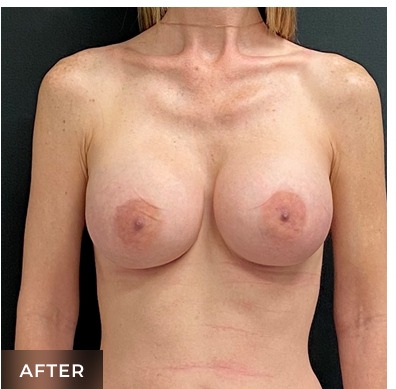Breast Augmentation Before & After Patient #15983