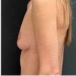 Breast Augmentation Before & After Patient #15983