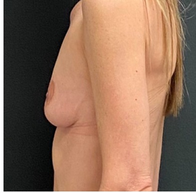 Breast Augmentation Before & After Patient #15983