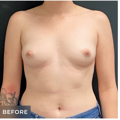 Breast Augmentation Before & After Patient #15984