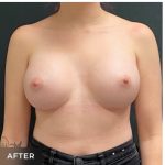 Breast Augmentation Before & After Patient #15984