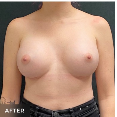Breast Augmentation Before & After Patient #15984