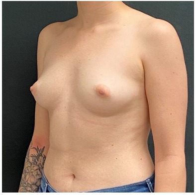 Breast Augmentation Before & After Patient #15984