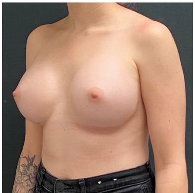Breast Augmentation Before & After Patient #15984