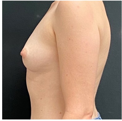 Breast Augmentation Before & After Patient #15984