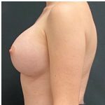 Breast Augmentation Before & After Patient #15984