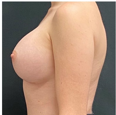 Breast Augmentation Before & After Patient #15984