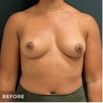Breast Augmentation Before & After Patient #15985