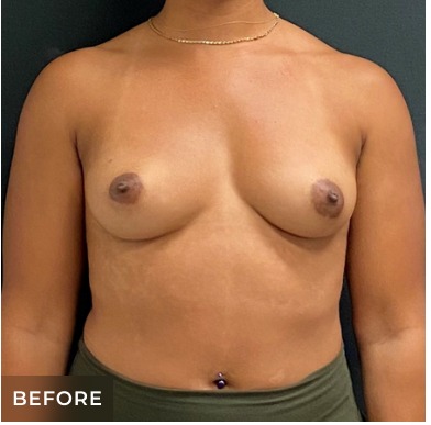 Breast Augmentation Before & After Patient #15985