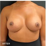 Breast Augmentation Before & After Patient #15985