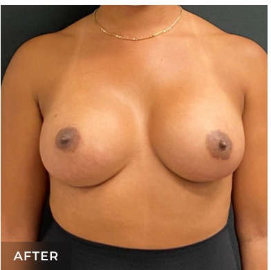Breast Augmentation Before & After Patient #15985