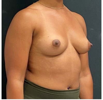 Breast Augmentation Before & After Patient #15985