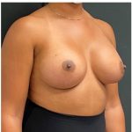 Breast Augmentation Before & After Patient #15985