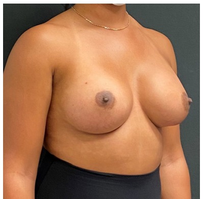 Breast Augmentation Before & After Patient #15985