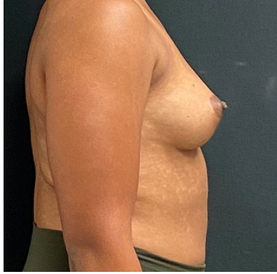Breast Augmentation Before & After Patient #15985