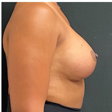 Breast Augmentation Before & After Patient #15985
