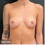 Breast Augmentation Before & After Patient #15986