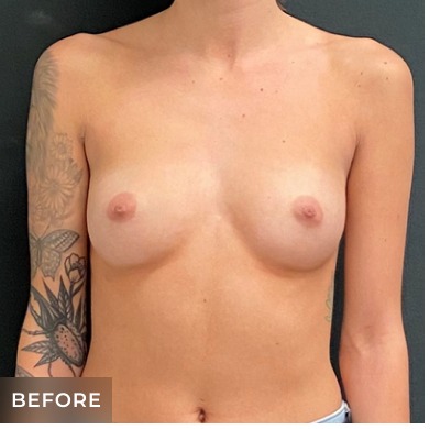 Breast Augmentation Before & After Patient #15986