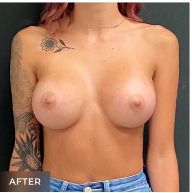 Breast Augmentation Before & After Patient #15986