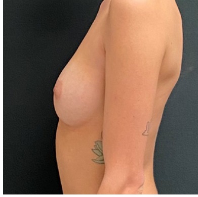 Breast Augmentation Before & After Patient #15986