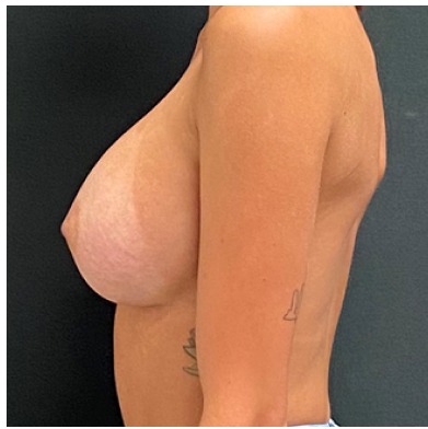 Breast Augmentation Before & After Patient #15986