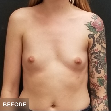 Breast Augmentation Before & After Patient #15987
