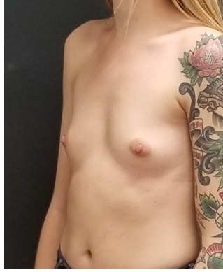 Breast Augmentation Before & After Patient #15987