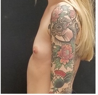 Breast Augmentation Before & After Patient #15987