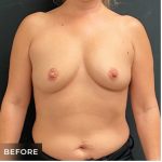 Breast Augmentation Before & After Patient #15988