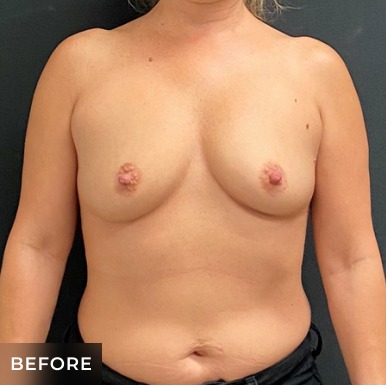 Breast Augmentation Before & After Patient #15988