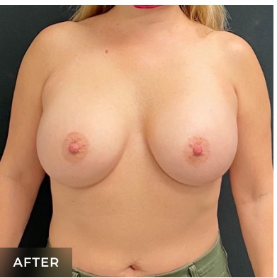 Breast Augmentation Before & After Patient #15988