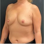 Breast Augmentation Before & After Patient #15988