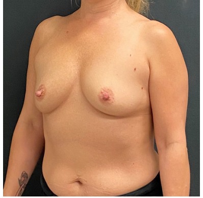 Breast Augmentation Before & After Patient #15988