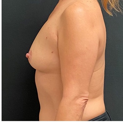 Breast Augmentation Before & After Patient #15988