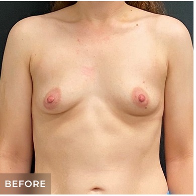 Breast Augmentation Before & After Patient #15989