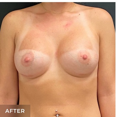 Breast Augmentation Before & After Patient #15989