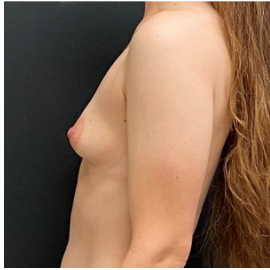 Breast Augmentation Before & After Patient #15989