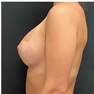 Breast Augmentation Before & After Patient #15989